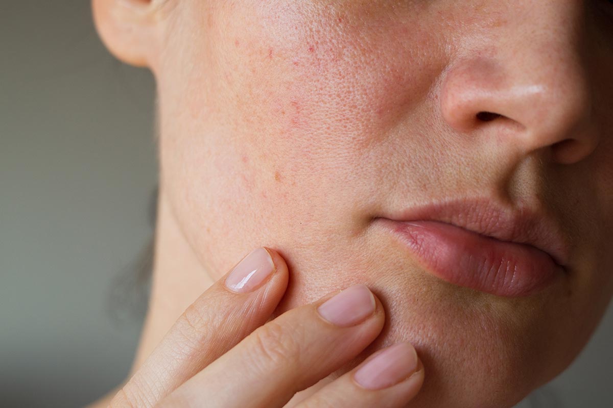 Lee más sobre el artículo Piel enrojecida –dermatitis-